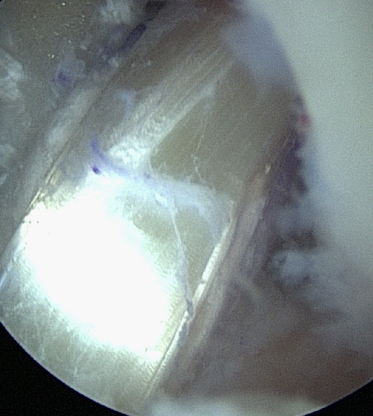Vordere Kreuzbandruptur Kreuzbandriss Orthopädie Aukamm
